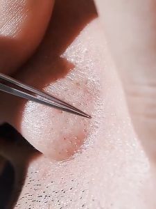 Stainless Steel Acne Extractor Blackhead Remover Tool 【SG Stock】