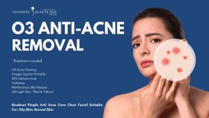 【O3 Anti-Acne Removal Treatment】Facial Treatment Acne Control Balanced Oil Production Improved Skin Texture