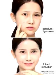 Acne and pimple remover Anti-freckle remove cream whtiening freckle cream to remove marks acne cream
