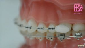 Pinkderby 1pc Ortho Wax: A Comprehensive Guide