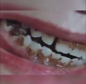 ORI 100% Pasta Gigi Berlubang Penumbuh Gigi Odol pemutih gigi dan karang Pembersih gigi kuning dan karang Menghilangkan bau mulut