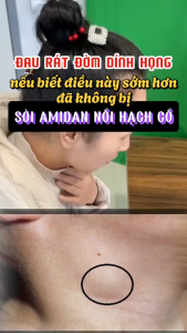 [SIÊU ƯU ĐÃI] COMBO Kem Thoa Làm Dịu Cổ Họng Giảm Đờm Đặc Các Triệu Chứng Viêm Họng Đau Họng Hiệu Quả