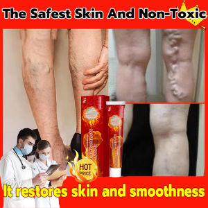 South Moon Varicose Vein Treatment Cream: A Comprehensive Guide