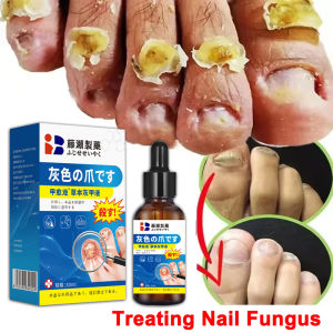 Nail fungus treatment Essence Japan Nail Repair Serum 100% Authentic Anti Infection Paronychia Onychomycosis Nail Foot Toe Nail Fungus Removal Effectively Repair Damaged Nails Remove Onychomycosis Promote Nails Growth 灰指甲精华30ML
