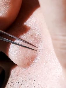 5in1 Acne Black Head Remover Tool Kit Stainless Steel Comedone Tool Pimple Extractor Besi Picit Jerawat 去黑头粉刺痘痘摄子