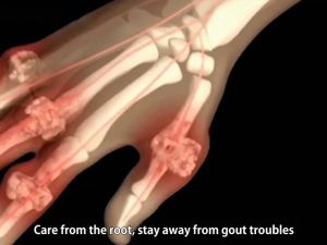High uric acid gout gel gout ointment Pain relief Reduce gout crystals Rheumatic bone pain relief natural herbs Get rid of gout in hands feet knees