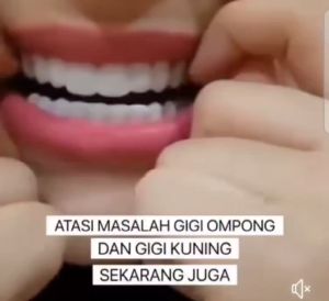 Veneer instan perapi gigi / Snap on smile Pengganti gigi palsu IFN