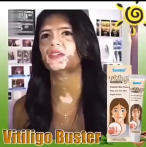 Kem Lang Ben Sumifun Tái Tạo Da - Giúp Xóa Mờ Các Vết Nấm Phục Hồi Sắc Tố Da & Mang Lại Làn Da Mịn Màng Đều Màu. Dễ Dàng Sử Dụng Hiệu Quả Và An Toàn