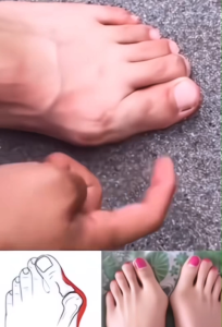 เครื่องมือแก้ไขนิ้วเท้าเอียง นิ้วโป้งเท้าบิด สำหรับเด็กและผู้หญิง ที่ปรับ หัวไม่เต็มเอียงให้เข้าที่ กระดูกนิ้วเท้าโป้งนูน แยกนิ้วเท้า ใช้ได้ทั้งเท้าซ้ายและขวา ไม่เจ็บ ใช้ได้ทั้งวันและคืน hp5183脚趾拇指外翻脚指头调节矫正器儿童 女士 分趾脚骨突出大母纠正器左右通用无痛矫正器日夜可用