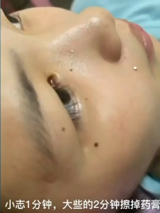 Kem chấm MOLE xóa nốt ruồi không để lại sẹo