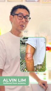 AOz Eczema Relief Ozonated Olive Oil (10/50ml). No Steroids or Parabens. Hypoallergenic. Therapy relief for Eczema Psoriasis Itchy Flaky and Sensitive Skin. Suitable for Young Children.