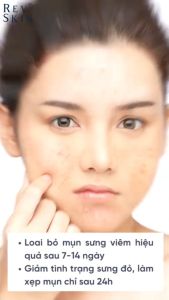 Kem bôi mụn REVSKIN ngừa thâm sẹo rỗ 10g- Tuệ Linh Garden- Hàng Nhập Chính Hãng