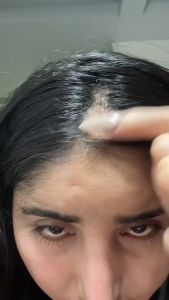 Minoxified 20% - maximized hair growth within a month