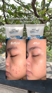DERMIES by ERHA Clear Me Ph Balance Facial Wash 60g - Sabun Pembersih Wajah Oily Skin