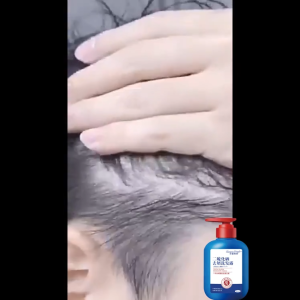 Dầu gội trị gàu 300ML loại bỏ gàu trị gàu ngứa chống nấm kiểm soát dầu dầu gội trị nấm phục hồi mạt tóc