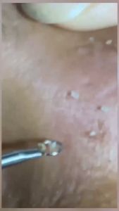 ALAT PENCETAN JERAWAT KOMEDO ISI 2PCS / PINSET JERAWAT KOMEDO LC18