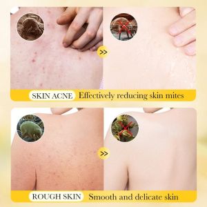 Ready Stock Original Sulfur Mite Removal Acne Body Wash Psoriasis Anti Itching Eczema Mite Removal Sabun Badan Sulfur Untuk Gatal jerawat badan硫磺沐浴露500ML