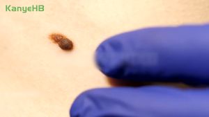 KanyeHB Wart Removal Liquid น้ำยาฆ่าเชื้อหูด 10ml