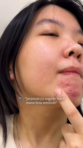 ILEEN GRACE - Acne Care Essences 30 ml | Kulit kering berminyak & sensitif | Jerawat | Bekas jerawat | Cegah jerawat