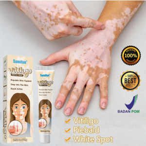 Krim Bercak Putih Menghilangkan Bintik Bintik Keringat Bintik Putih Vitiligo Depigmentasi Kulit Perawatan Tubuh Kesehatan Antibakteri Perawatan Rehabilitasi Kulit 20g