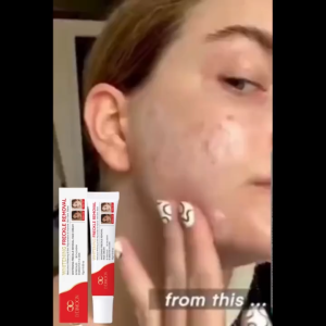 Krim penghilang flek hitam 15g Whitening blemish Whitening freckle cream Mencerahkan Kulit Efektif  Anti melasma Penghilang flek hitam di wajah /Age spots/Freckle/Bintik noda/Jerawat