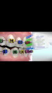 Bàn chải dành cho răng niềng Coral Clean với mặt bàn chải cong chữ U