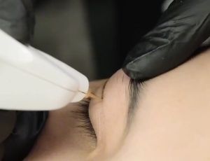 Máy Plasma nhấn mí đốt nốt ruồi mụn thịt xóa nhăn | Máy đốt Plasma