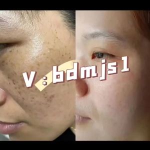 💗🙋‍♀️💗淡巴痕净疤膏烫伤烧伤产后术后修复草本配方平疤膏不留痕一件代发