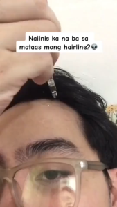 【BUY 1 TAKE 2】Hair Growth Serum for Fuller Hair with 15% Minoxidil Allergy-Free30ml