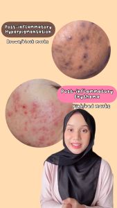 Neostrata Enlighten Dark Spot Corrector | 20g