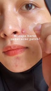 Acne Patch Pereda Jerawat PE / Sticker Tempel Siang Malam Pengempes Jerawat Waterproof