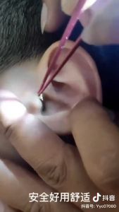 Ear Cleaner LED Flashlight Earpick Wax Removal Tweezer Luminous Stainless Steel Tweezer Remover