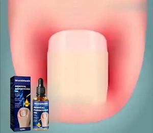 Anti Paronychia Relief Oil Ingrown Toenail Anti Fungal Toe Nail Ingrown Corrector Stop Pain Onychomycosis Treatment Serum 100% Effective Onychomycosis Paronychia Nail Repair 10ml