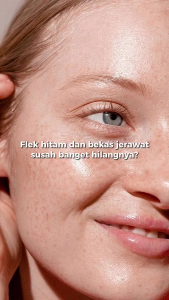JGlow Paket Spot Exfoliating - Paket Skincare Perawatan Kulit Berflek Noda Hitam Bekas Jerawat