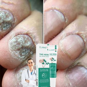 Nail repair Cream 15g Nail fungus treatment nail care cream anti-cracking fungal infection Quickly repair damaged nails Safe Chinese Herbal Medicine