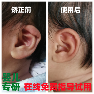 Ear Brace Baby Newborn Orthosis Wind Ear Baby Hair-Styling Equipment Lop-Ear Correction Stickers Auricle