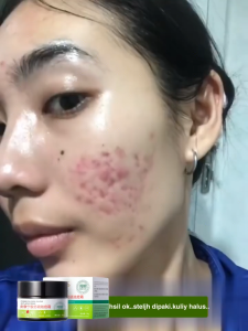 30g Krim Penghilang Bekas Jerawat Obat Lubang Jerawat Penghilang Bopeng Krim Wajah Penghilang Flek Hitam Kusam Perawatan Jerawat Parah Krim Totol Jerawat Membandel Obat Jerawat Bruntusan Acne Spot Cream Mengeringkan Jerawat Meradang