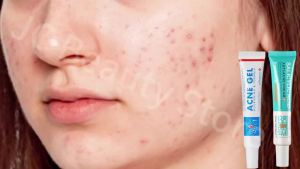 SADOER | Salicylic Acid Acne Faded Face Cream Reduce Pimple Spots Deep Cleaning Pore Anti-acne Scar Oil Control Moisturizer Skin Care