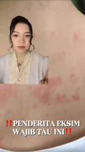 PREPARE Salep Eksim Paling Ampuh Obat Gatal Penghilang Jerawat Punggung Lotion Untuk Kulit Kering