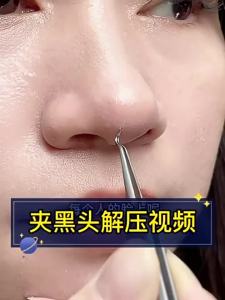 YISHE | Fine Blackhead Remover Pimple Extractor Kit