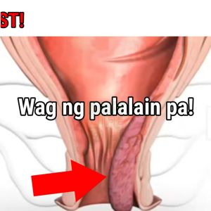 100% SAFE & EFFECTIVE Hemorrhoids Treatment Cream Chinese Herbal Extracts Hemorrhoids Internal External Piles Anall Fissure Pain Relief