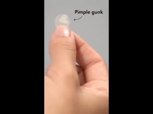 360Pcs Pimple Patches for Face Hydrocolloid Acne Patches Cute Star Zit Covers Colorful Spot Sticker Pimple Patches for Face 360pcs Hydrocolloid Patches for Covering Zits and BlemishesGentle and Non Irritating Colorful Breathable Acne Pimple Patch