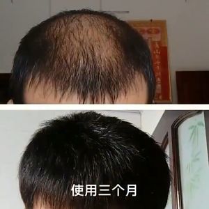 Ginger Hair growth for men and women hair growth serum hair growth hair growth spray hair growth essence oil Growth Beard Hair growth