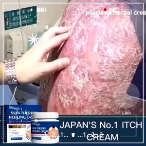 SKIN ANTI-ITCH CREAM South Moon Skin Therapy Healing Cream Anti-Itch Antibacterial Psoriasis Treatment