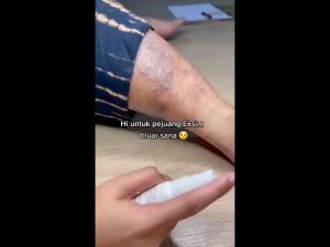 Protivo Natural Cream / Obat Jerawat / Obat Gatal Eksim Panu Kadas Scabies Kurap dan Kutu Air