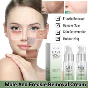Mole And Freckle Removal Cream Anti-Pekas & Freckle Lightening Cream Hydrating Moisturizing Whitening Facial Cream