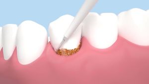 Teeth Cleaner Tartar Ultrasonic Tooth Cleaner Machine Teeth Whitening and Tartar Remover Dental Scaler for Teeth Usb Electric Tooth Brush Electric Ultrasonic Toothbrushes for Adult