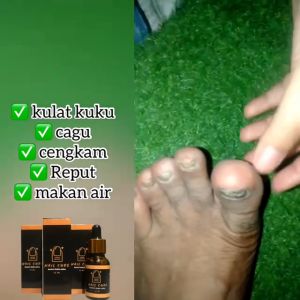 [ORIGINAL] UBAT KUKU/RAWAT KUKU CEKAM (NAIL CURE)