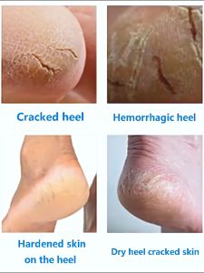 Luxurious Moisturizing Foot Cream - Rapid Repair Formula for Dry Cracked Heels | Anti-Crack Treatment Cream for Soft Supple Feet