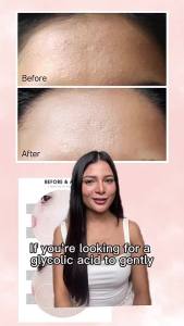 Cosrx AHA 7 Whitehead Power Liquid 100ml: A Gentle Chemical Peel for Acne Treatment